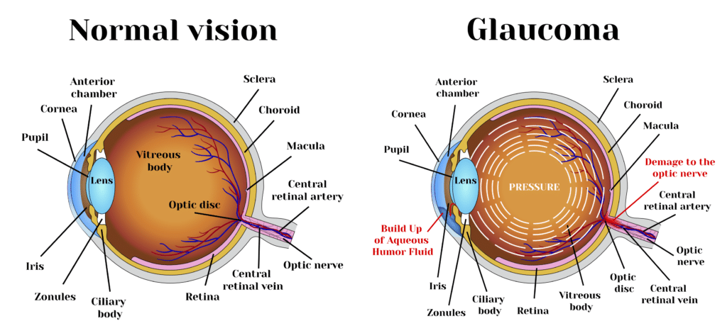 Cannabis Treatments for Glaucoma, Ocular Disease, Eye Disease