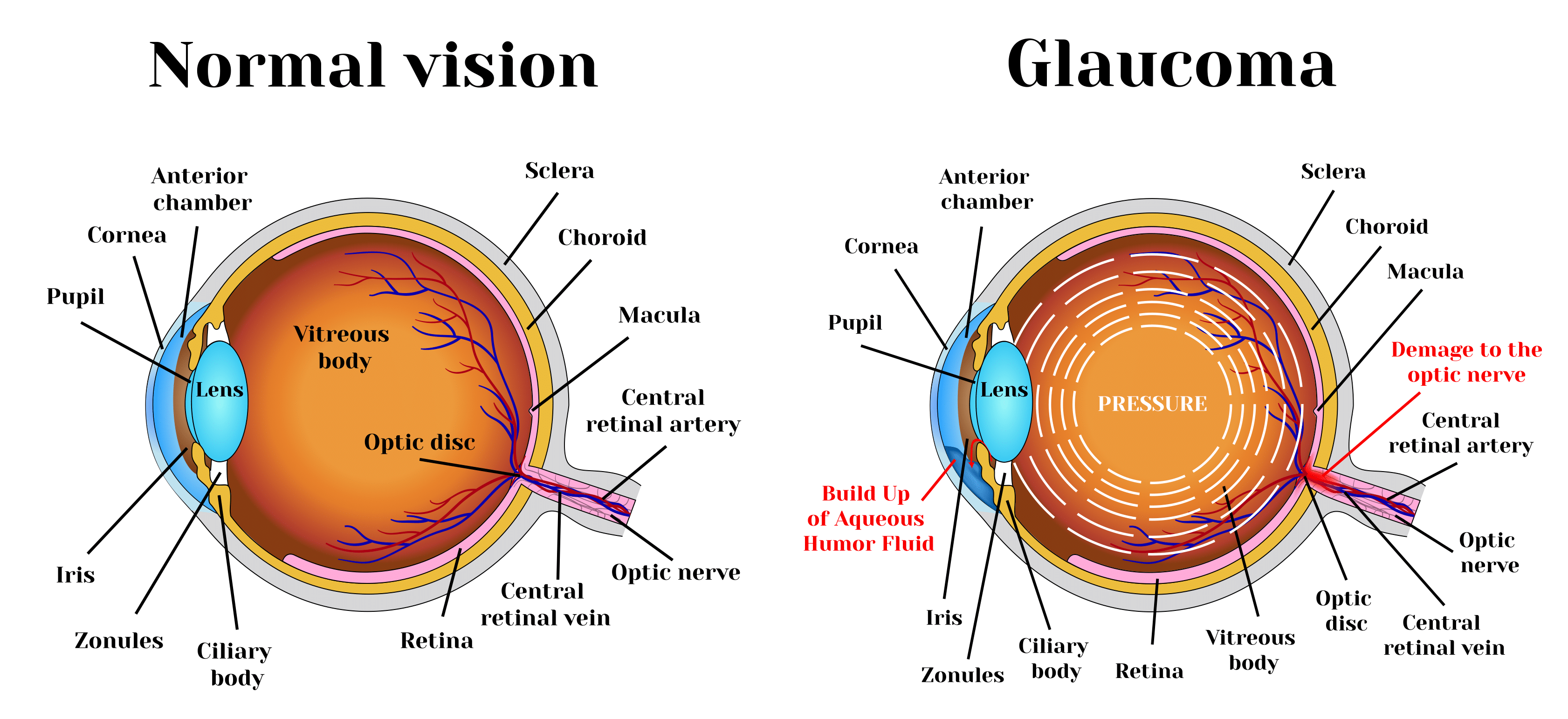 What Is Glaucoma Learn About Glaucoma Glaucoma Resources