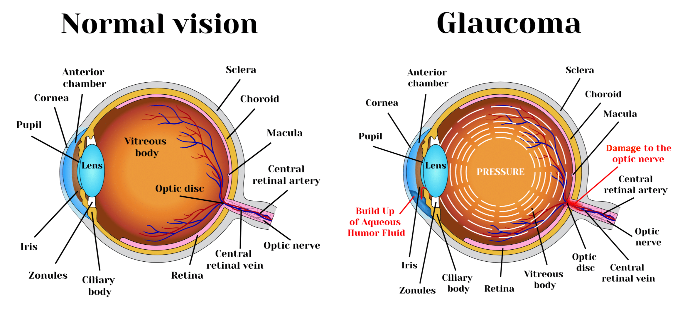 What Is Glaucoma Learn About Glaucoma Glaucoma Resources